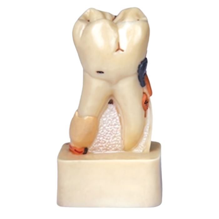 Dissected Model of Dental Disease