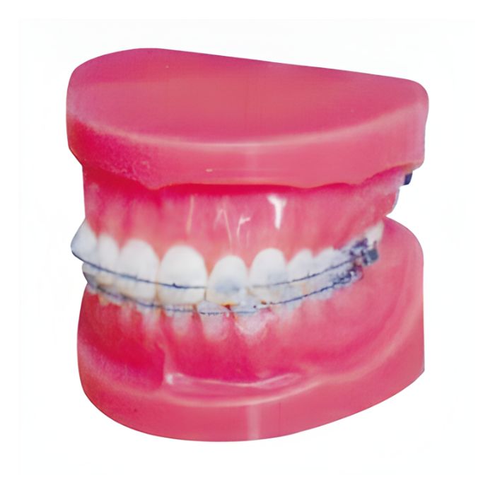 Fixed Orthodontic Model (Normal)