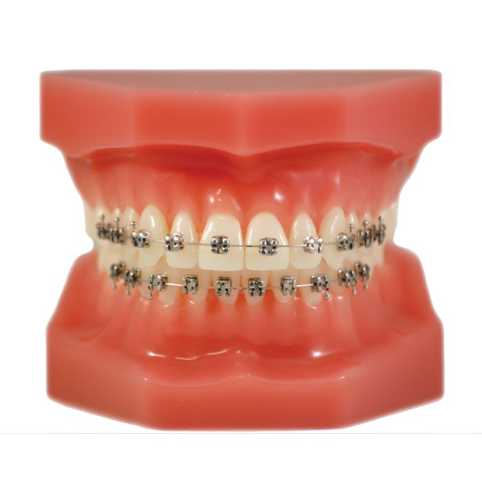 Fixed Orthodontic Model (Normal)