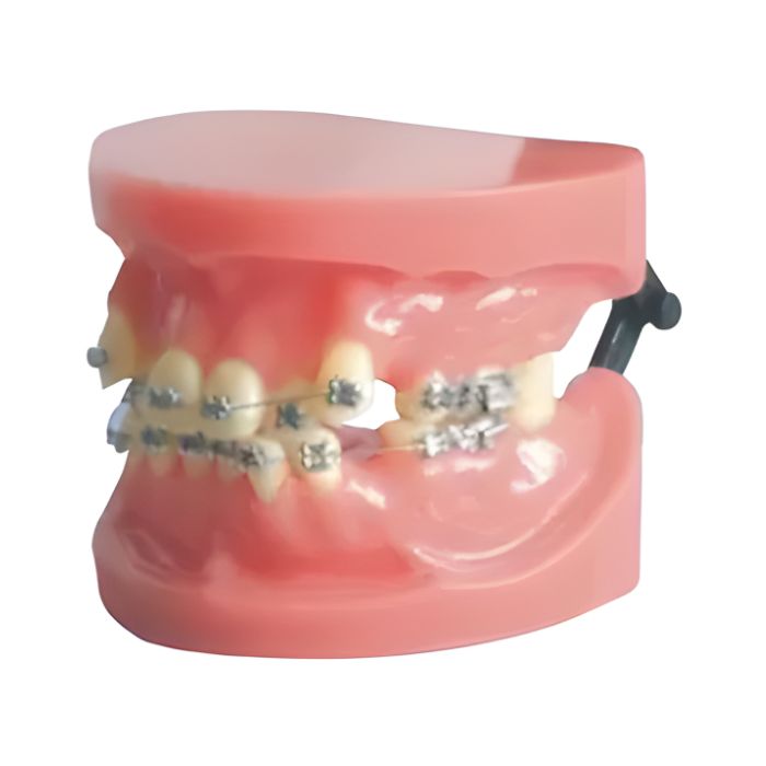 Fixed Orthodontic Model (Dislocation)