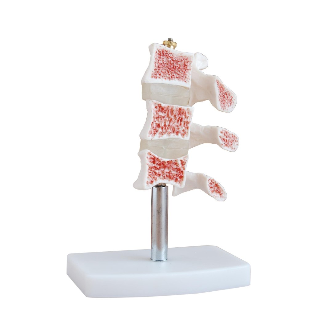 Cutaway Osteoporosis