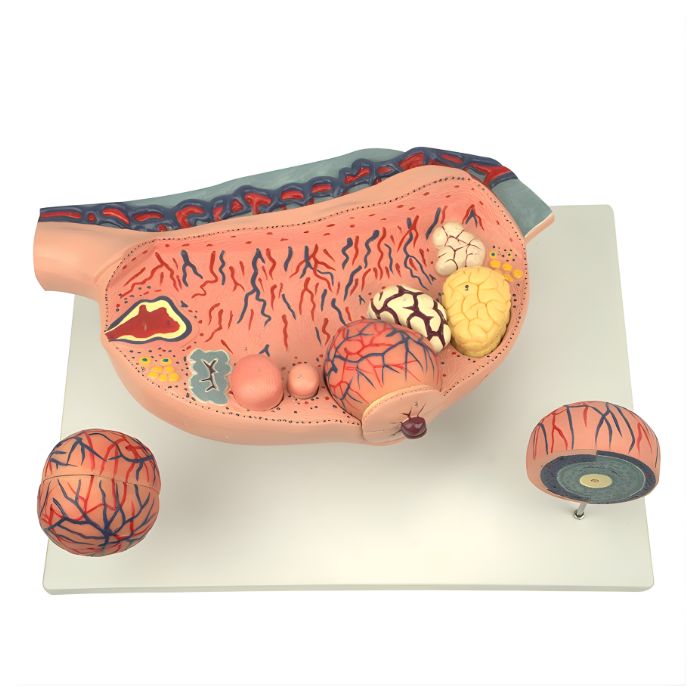 Enlarged Ovary